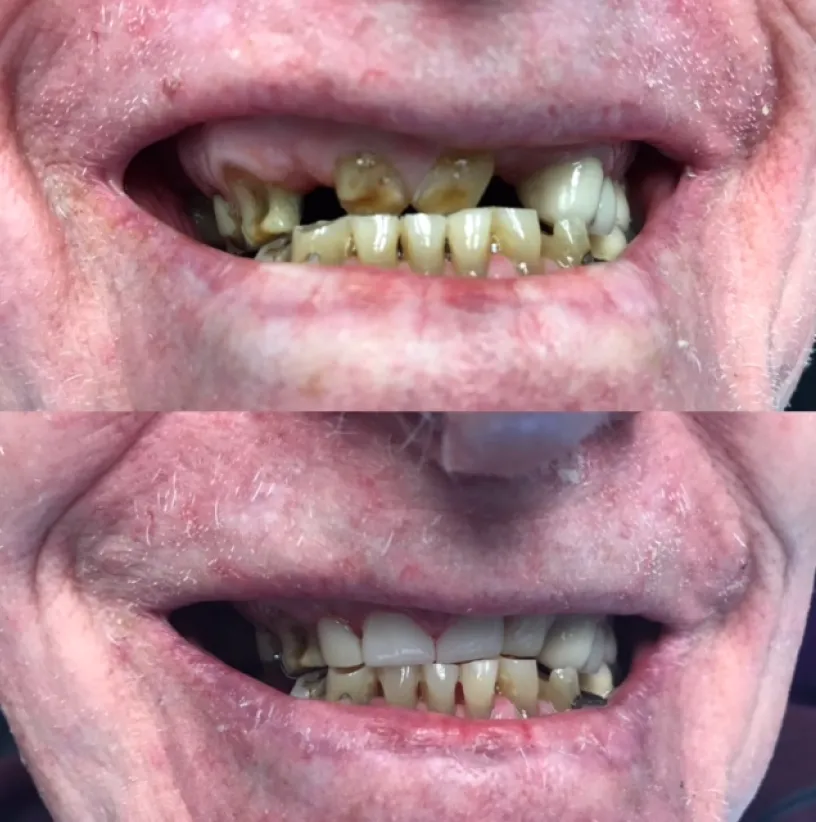 Before and after dental treatment showing improved tooth alignment and whitening results.
