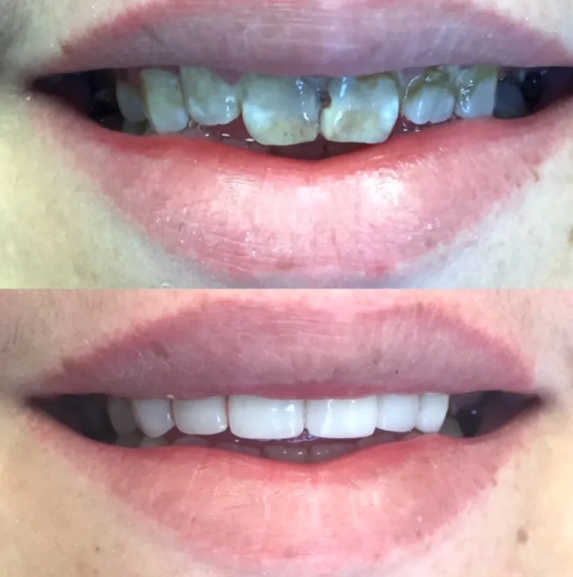 Before and after dental treatment showing whitened and straightened teeth transformation.