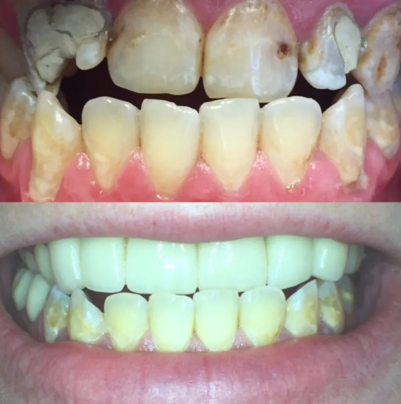 Before and after dental restoration showing improved tooth color and alignment with dental crowns.