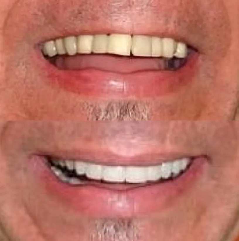 Before and after dental smile comparison showing improved teeth alignment and whiteness.