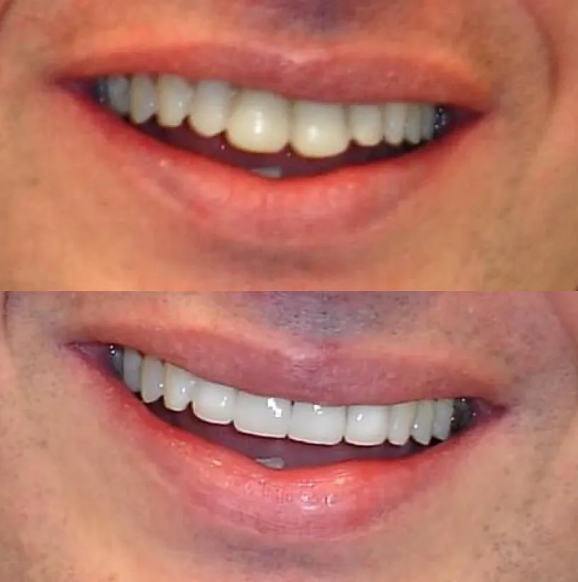 Before and after comparison of teeth whitening results showing brightened smile