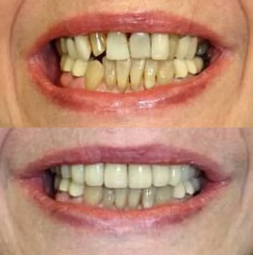 Before and after dental treatment comparison showing improved tooth alignment and appearance.
