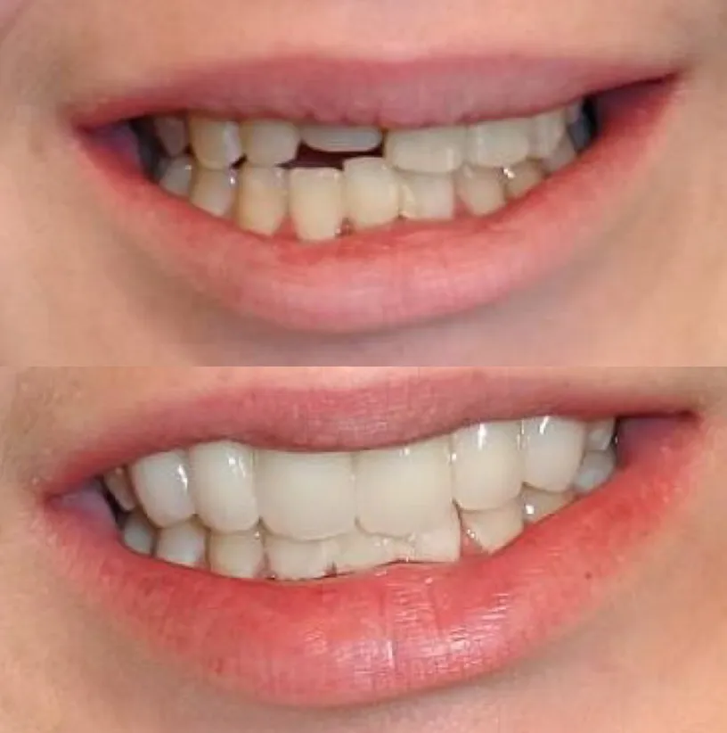 Before and after dental treatment comparison showing improved tooth alignment and whiteness.