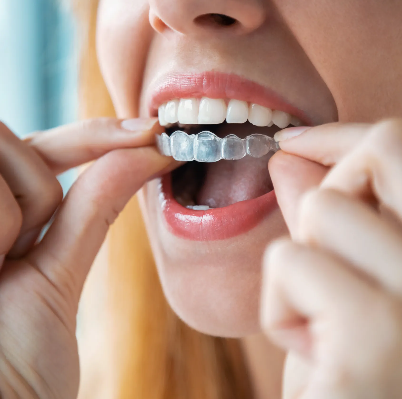 Woman inserting clear dental aligner tray into mouth for orthodontic treatment.