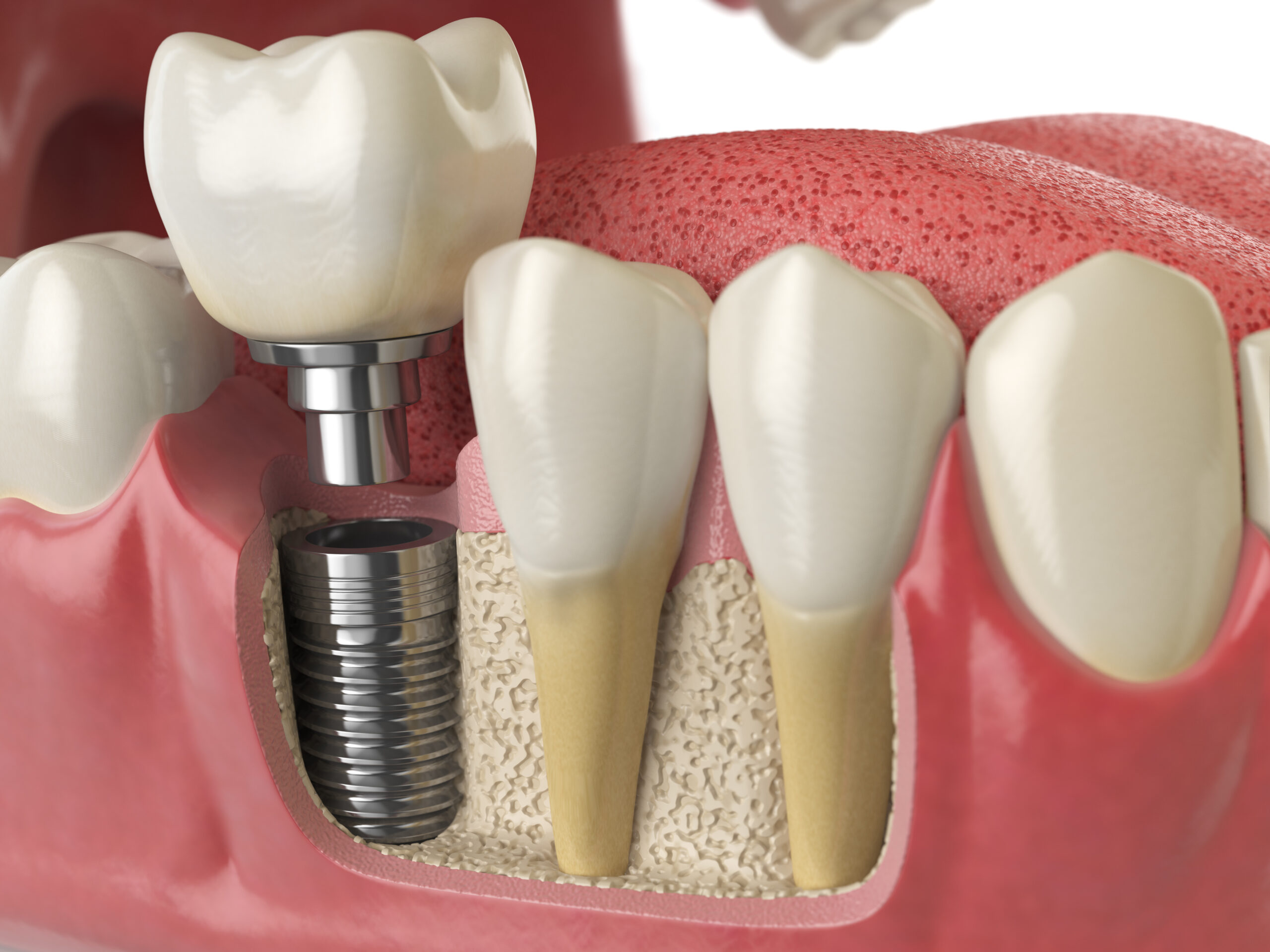 What to Expect When You Get Dental Implants