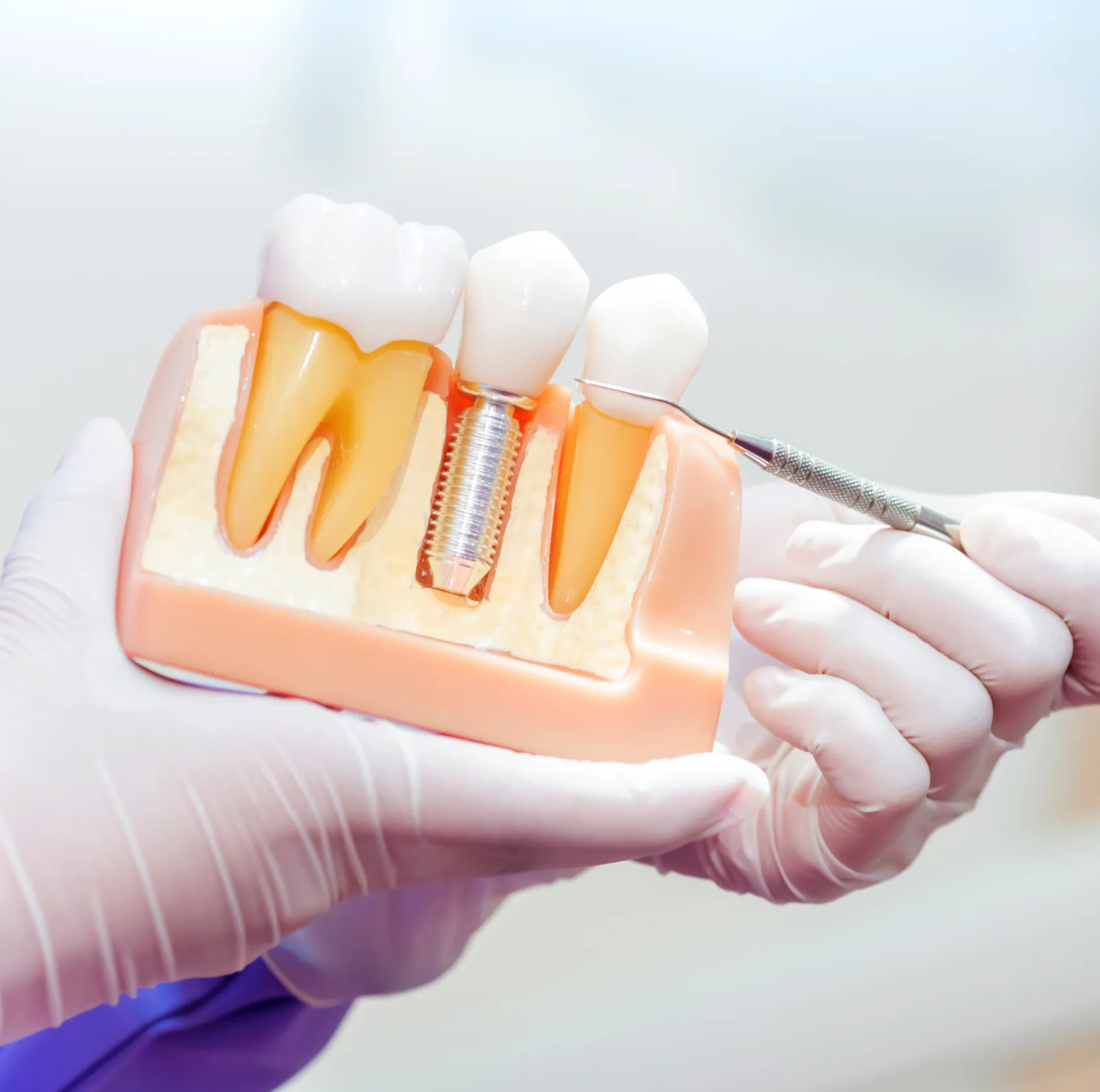 Dentist in gloved hands holding dental implant model showing tooth replacement procedure and implant structure.