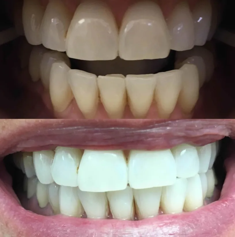 Before and after dental restoration comparison showing natural-looking tooth crowns and veneers.