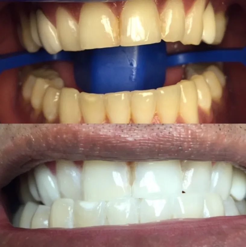 Before and after dental whitening comparison showing yellowed teeth transformed to bright white teeth with blue shade guide.