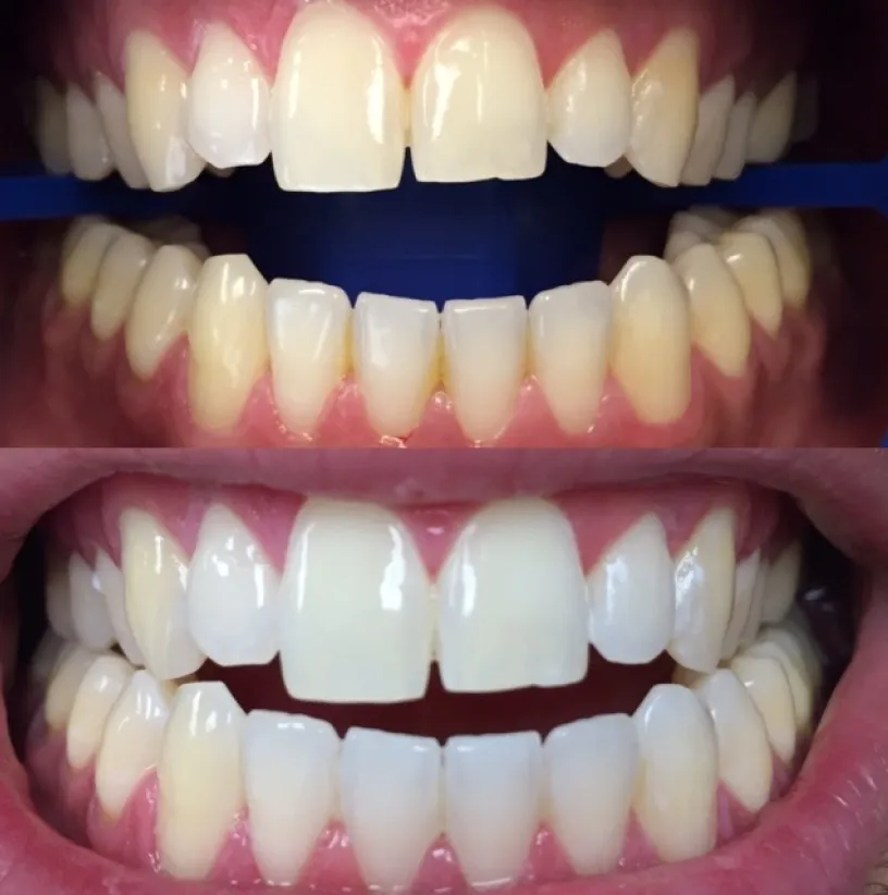 Before and after dental whitening results showing brightened upper and lower teeth.