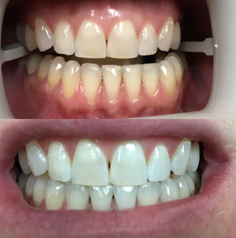Before and after dental veneers showing improved tooth color, shape, and alignment transformation.