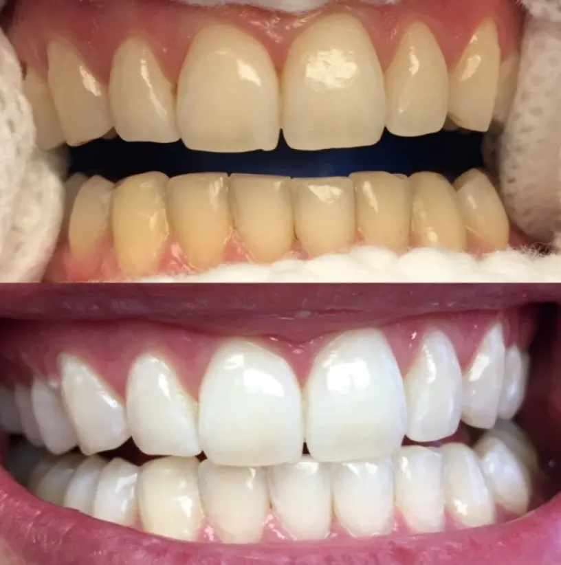 Before and after dental whitening comparison showing yellowed teeth transformed to bright white smile.