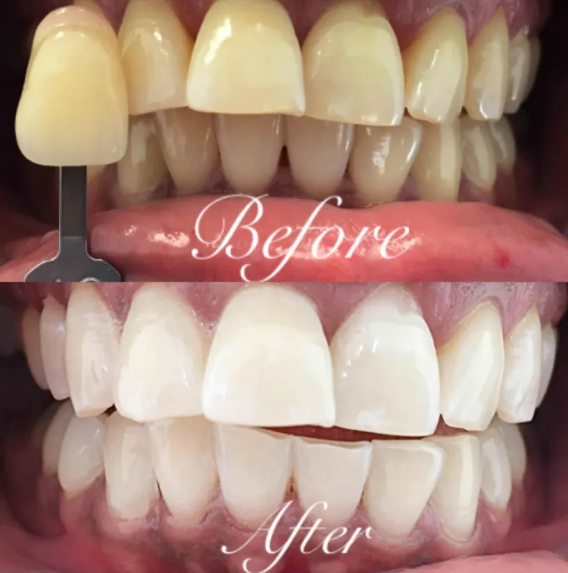 Before and after dental veneers comparison showing yellowed teeth transformed to bright white teeth