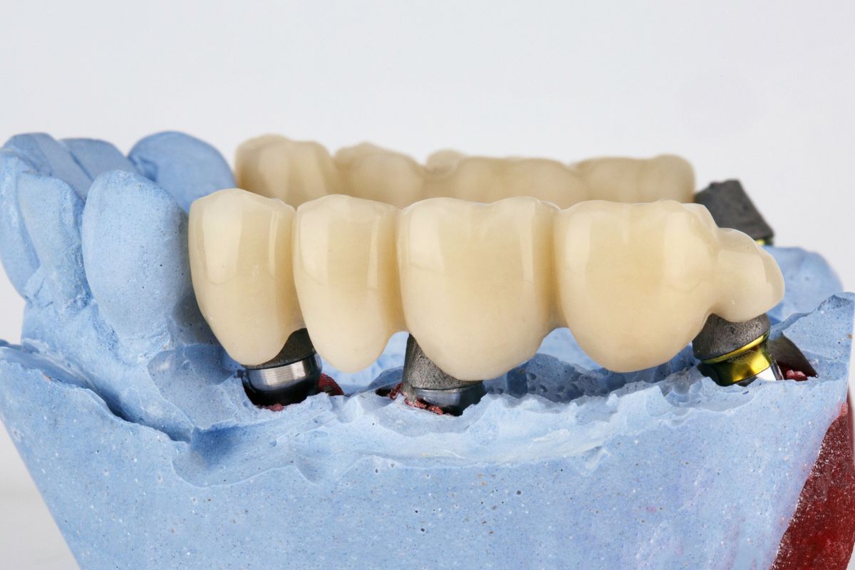 How to Care for Your Dental Crown: Maintenance Tips for Longevity