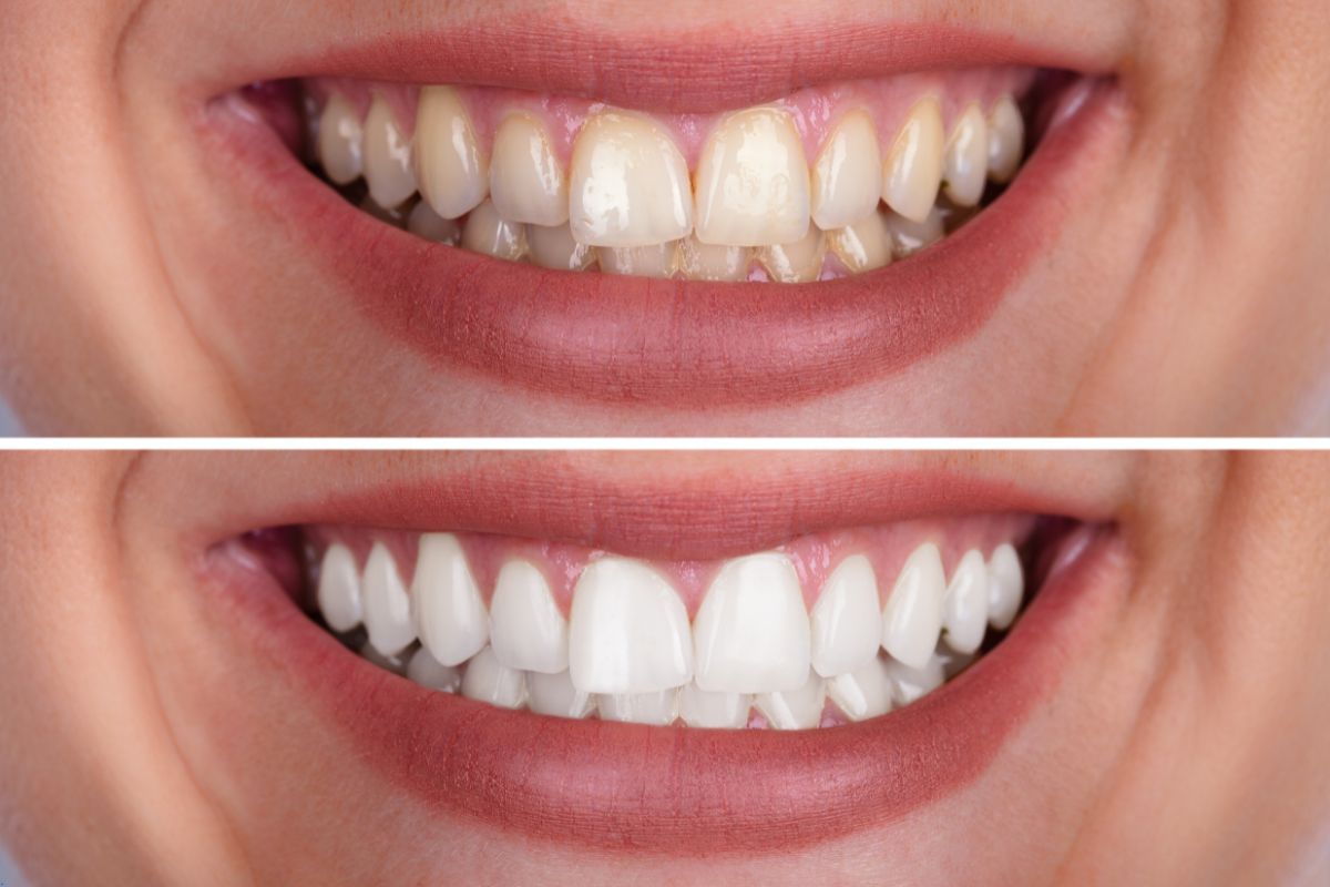 Teeth whitening Lagrangeville