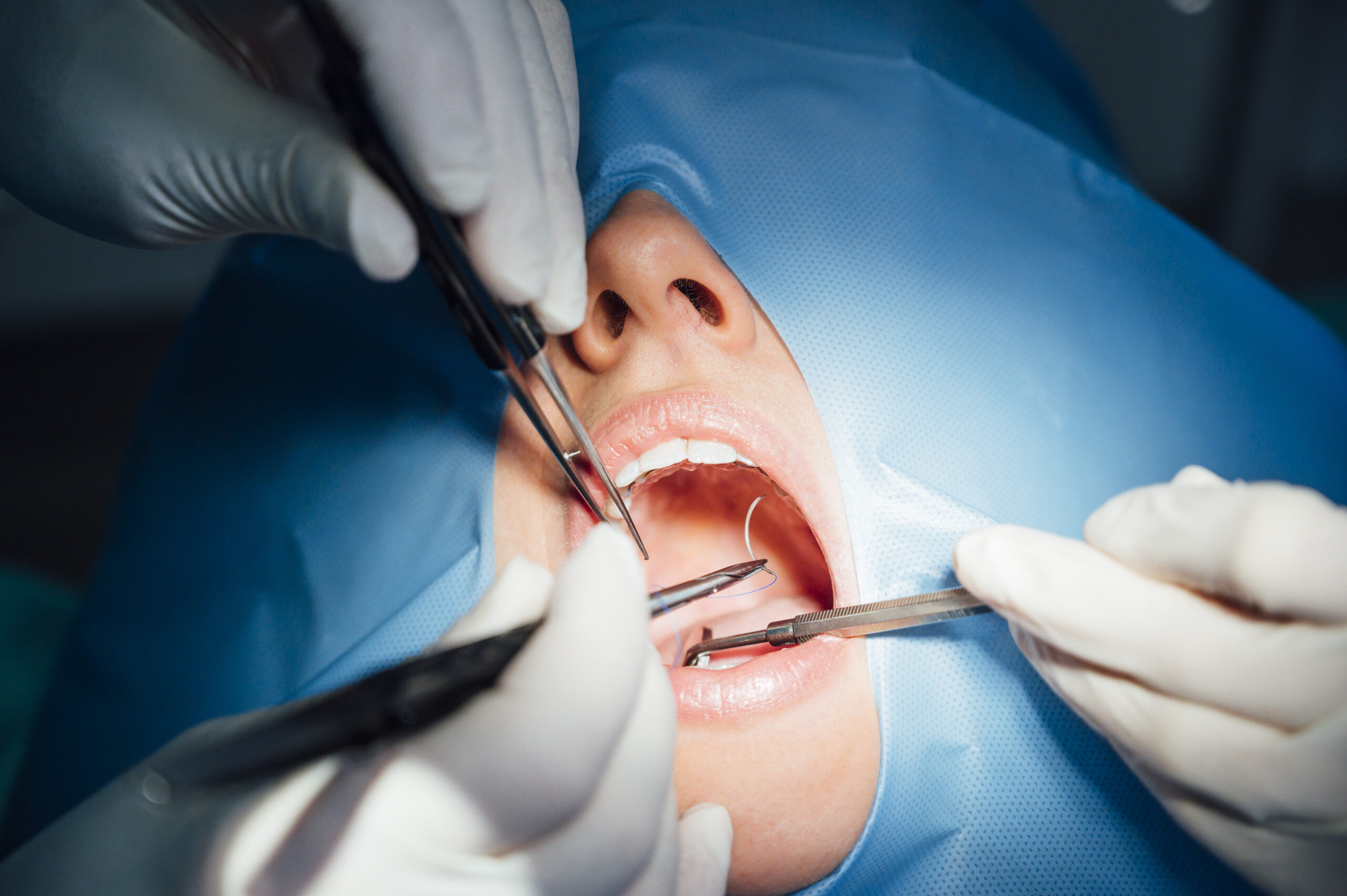What to Expect Before, During, and After a Tooth Extraction