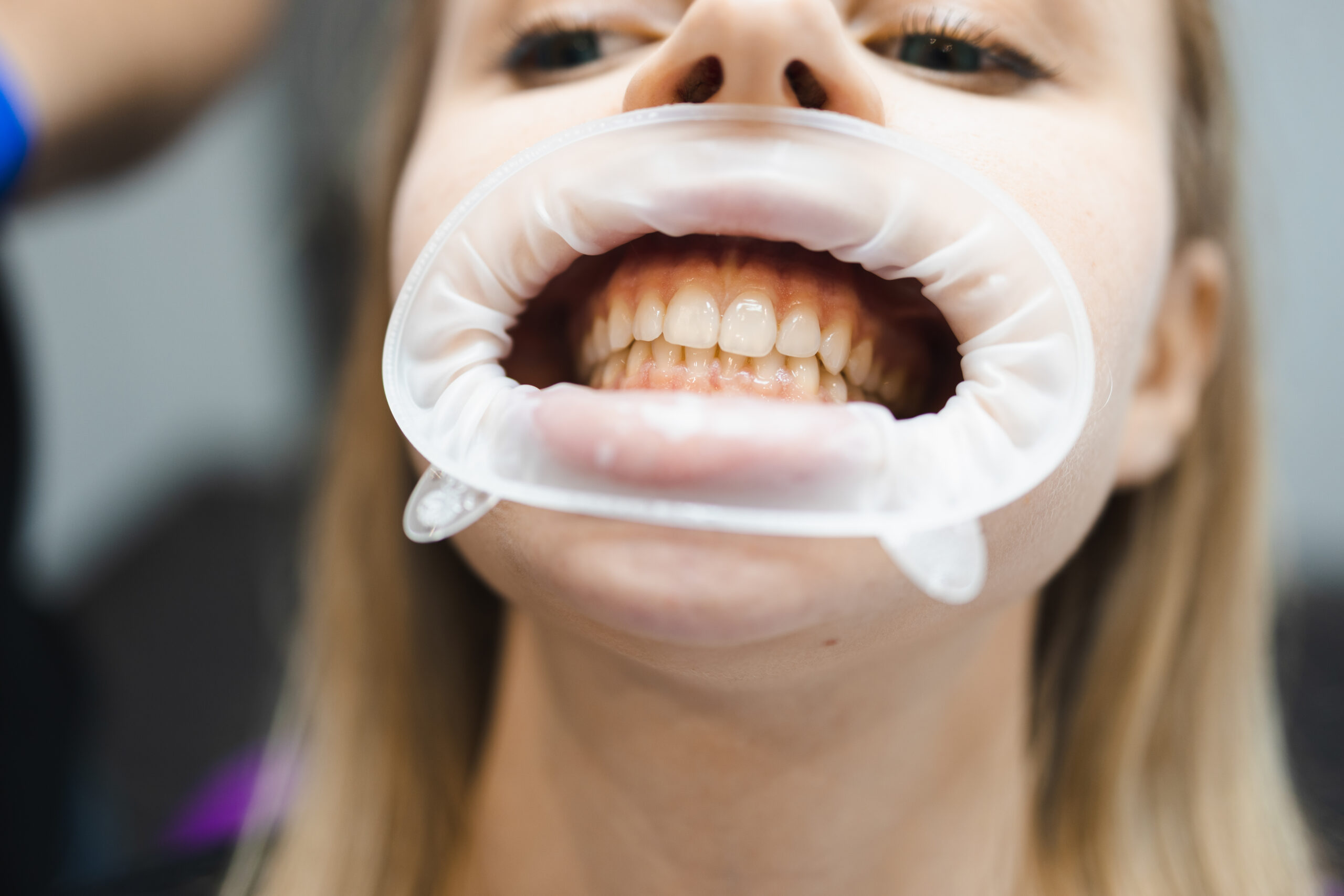 Before whitening your teeth: 5 things you need to know