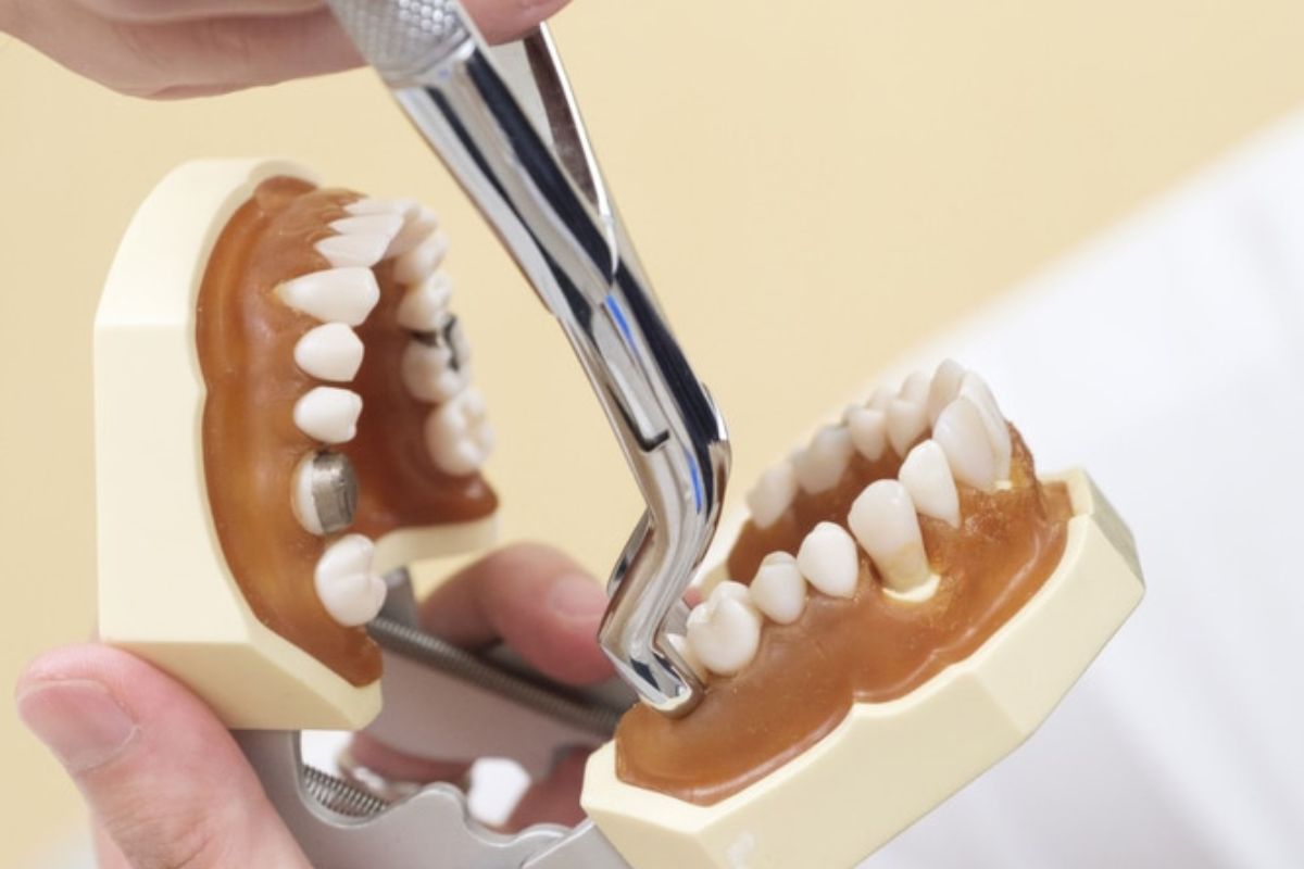 tooth extractions lagrangeville