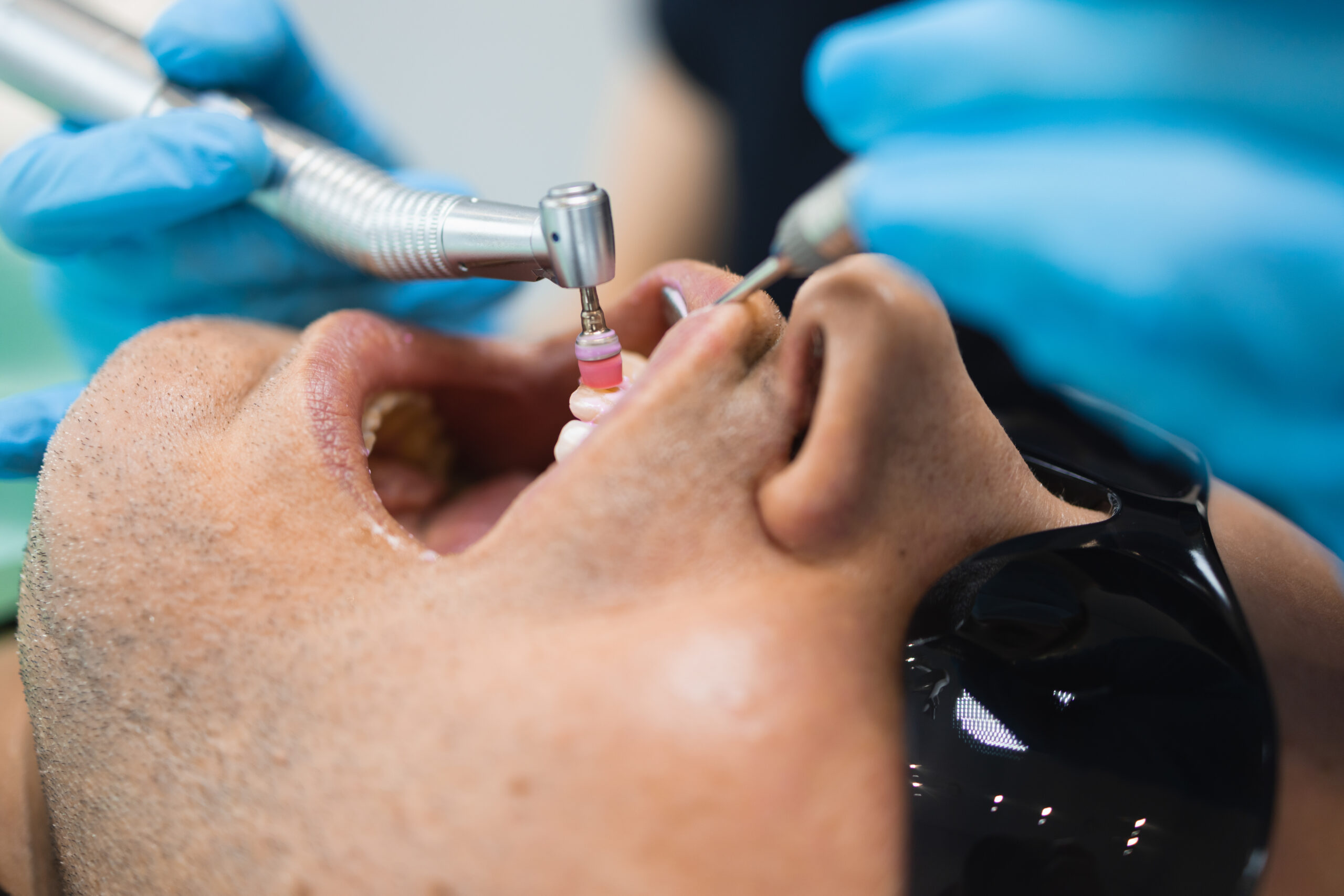 How Do Dentists Remove Tartar?