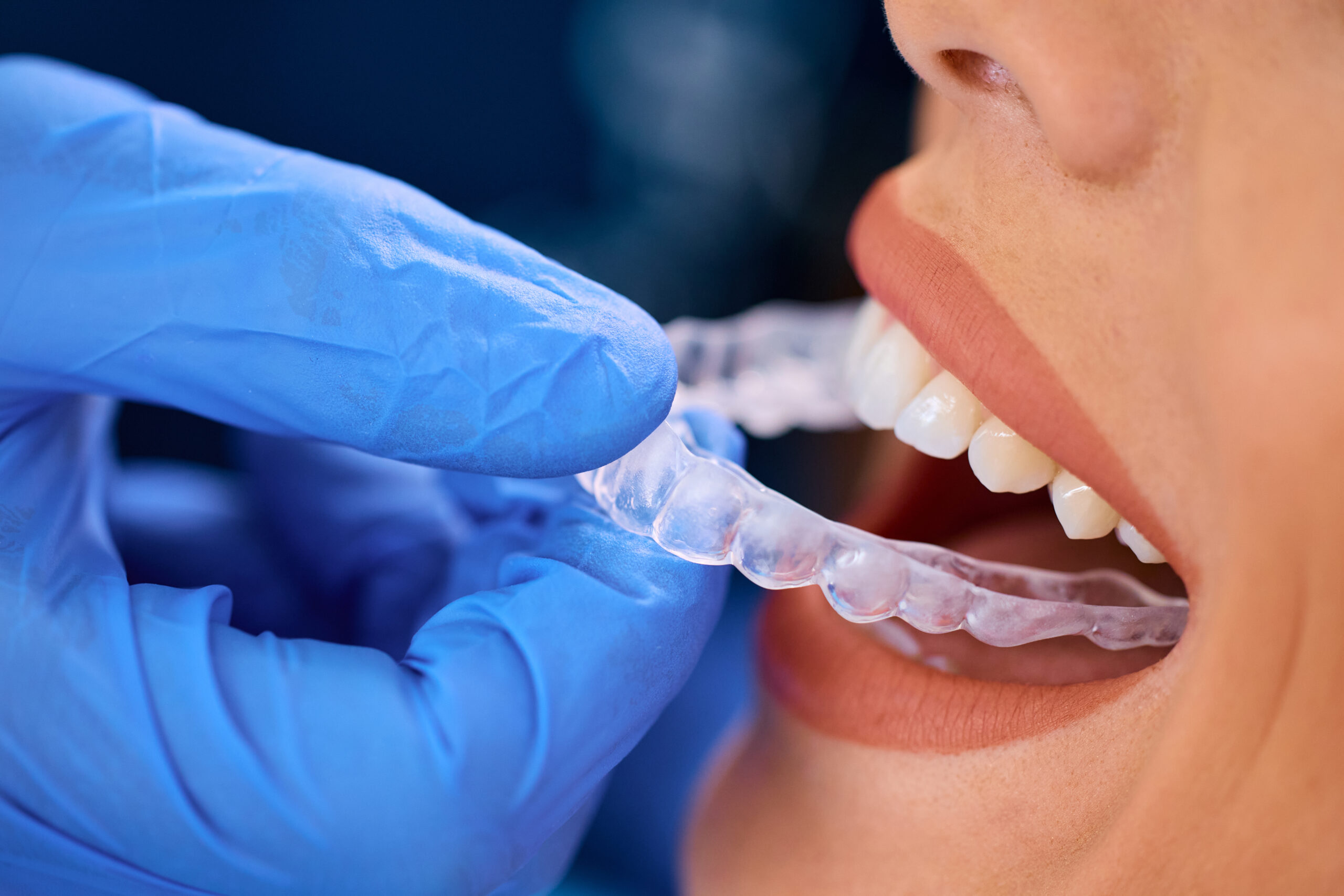 How Does Invisalign Work to Straighten Teeth?