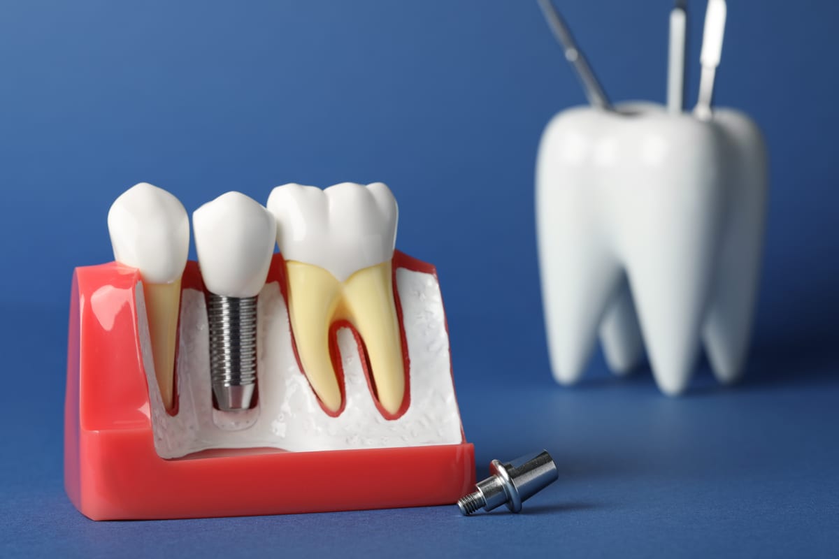 Dental Implants in